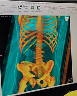 3d-rendering-of-torso-showing-hip-fractures.jpg Three-Dimensional Scan and CT Scan