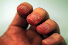 principles_of_dna_08_-_fingernails.jpeg Photo of red/sore fingernails